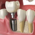 Почему необходимо своевременное протезирование зубов?